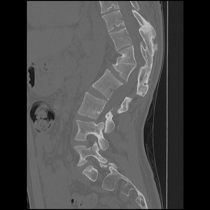 Congenital Kyphosis CT